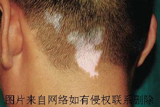 白癜风造成的原因有哪些呢