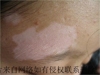 治好的白癜风复发了是什么原因