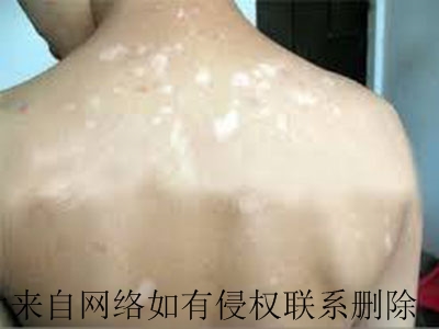 男性白癜风要怎么良好来治疗