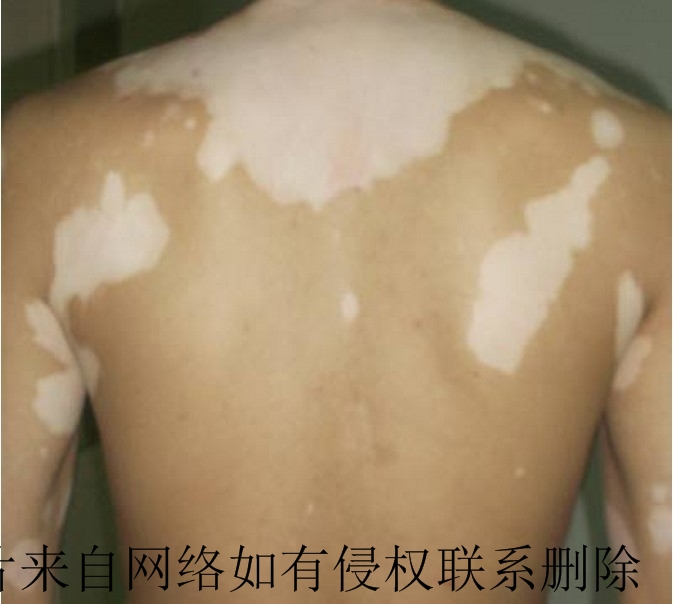 白癜风患者喝水要注意什么