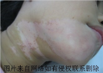 女性白癜风的常见危害