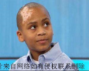 白癜风的严重危害性有什么