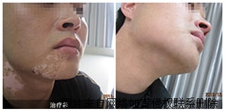 导致白癜风常见的因素是有什么