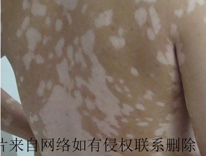 白癜风患者如何日常护理