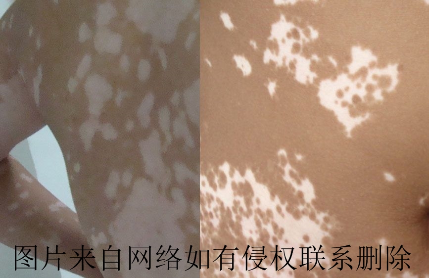 引发白癜风复发的原因有哪些