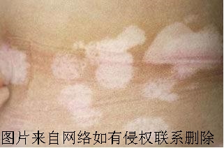 怎么减少白癜风带来的危害