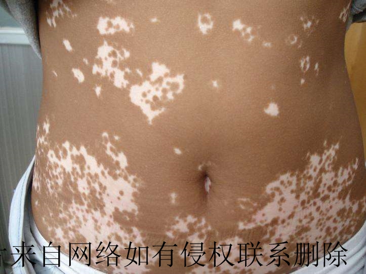腰部白癜风瘙痒怎么办好