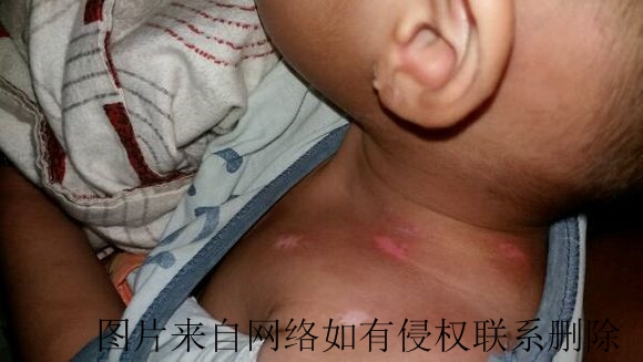 儿童患肢端型白癜风有哪些症状