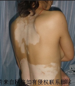 女性白癜风医治重点有哪些