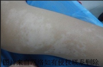 白癜风护理中注意哪些事情