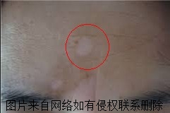 白癜风晚期有什么症状