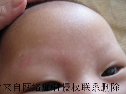 婴儿为什么会患上白癜风