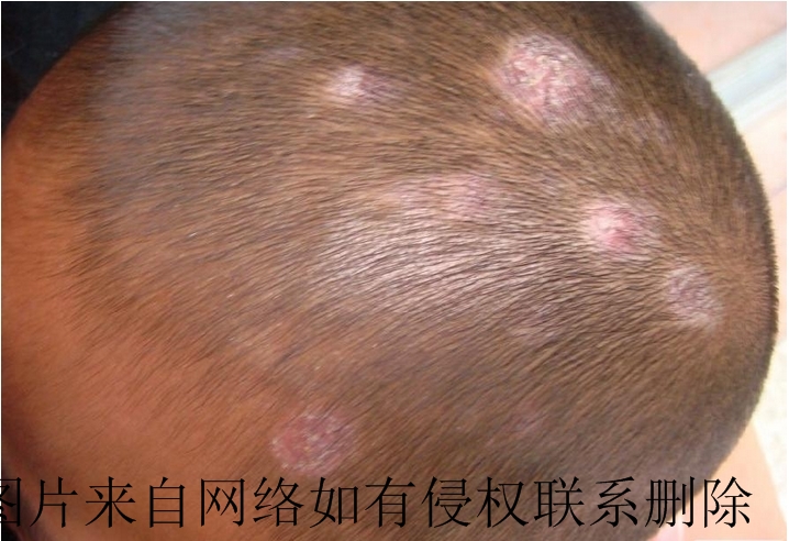 儿童白癜风带来哪些危害