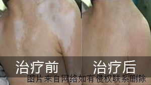 白癜风患者怎么来调节心理