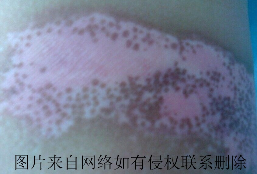 白癜风治疗中注意什么事项