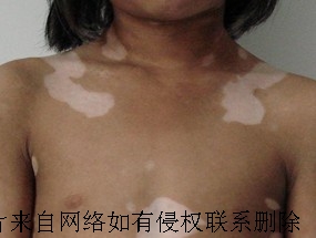 白癜风为什么会反复发作