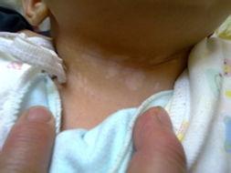 白癜风初期症状是什么样子