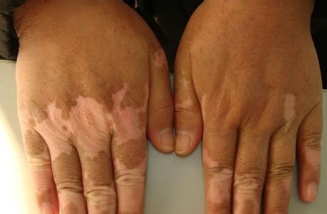 白癜风能治好吗