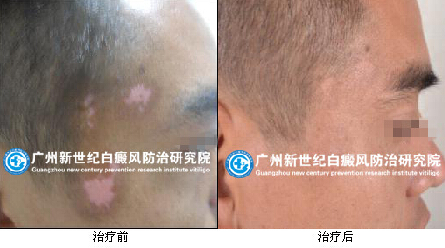 白癜风久治不愈的原因