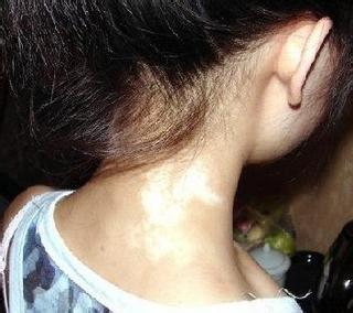 脖子上长了白斑是不是白癜风