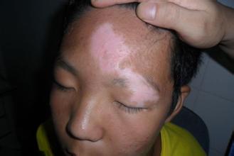 额头长白斑怎么办