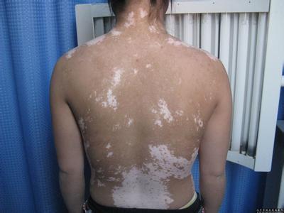 白癜风的症状有哪些