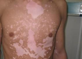 男性白癜风初期症状