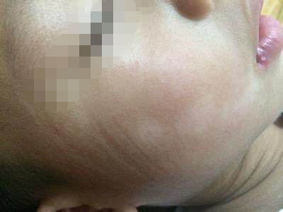 小孩脸上有白斑怎么办