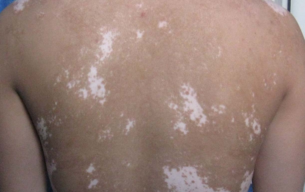 白癜风怎么治疗好得快 白癜风怎么治疗好得快