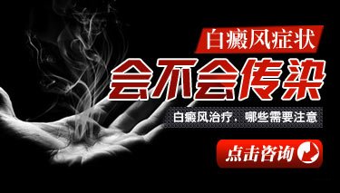 白癜风症状会传染吗 白癜风症状会传染吗