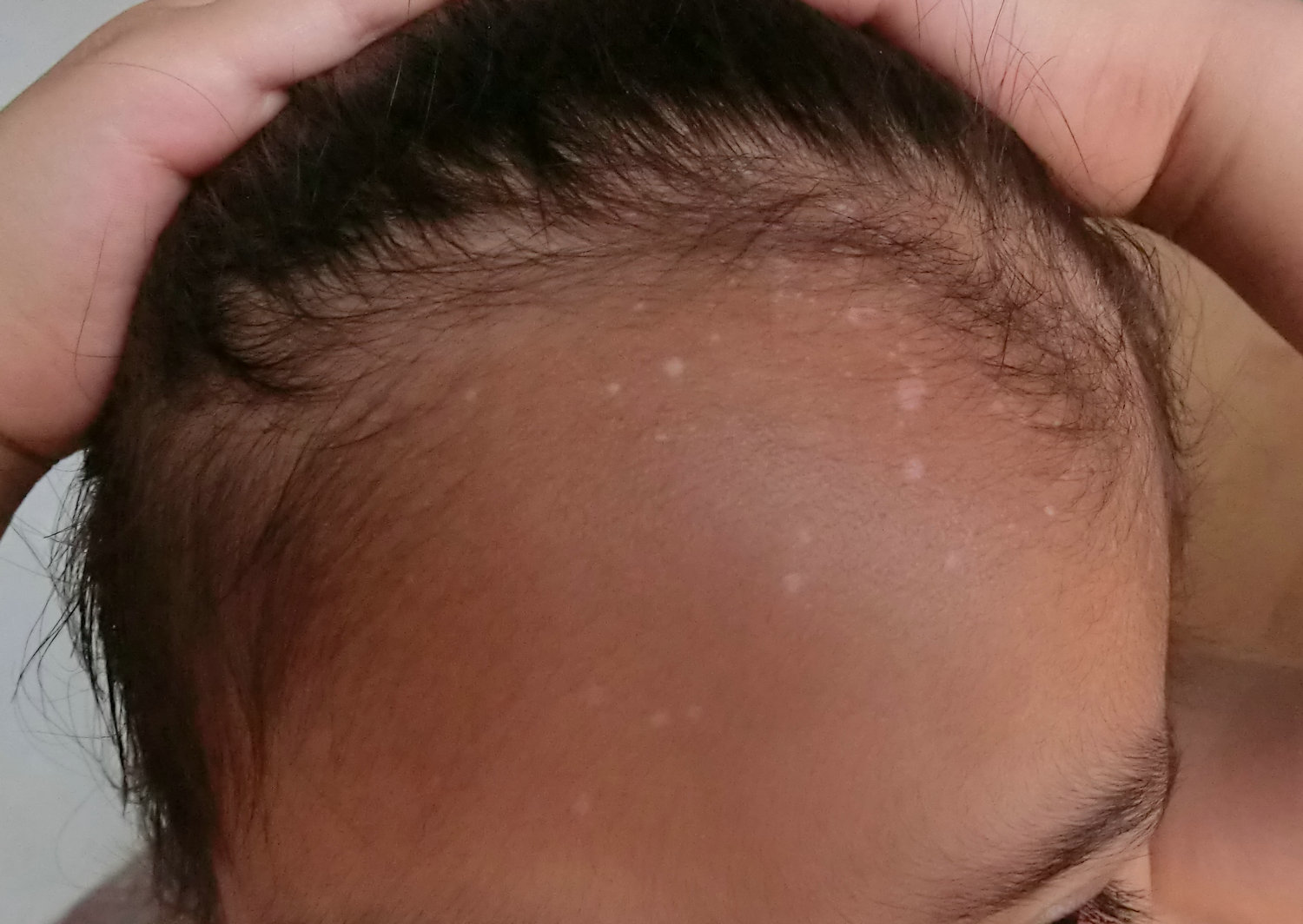 脸上长了一颗颗白点