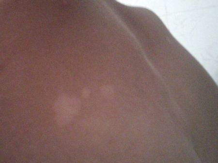 身上长白点是怎么回事