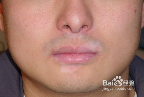 小孩脸上有白斑图片