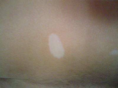 白癜风的早期症状