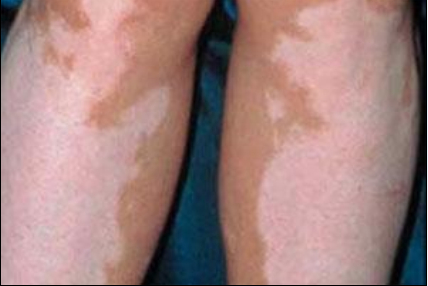 为什么会得白颠疯