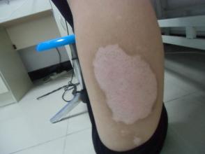 白癜风图片 白癜风图片