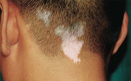 白癜风图片 白癜风图片