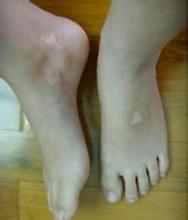 白癜风图片 白癜风图片