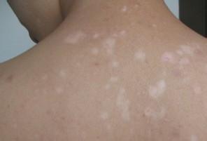 白癜风图片 白癜风图片