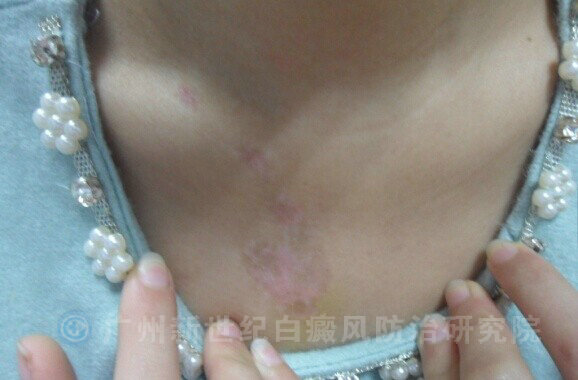 白癜风图片 白癜风图片
