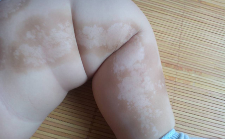 白癜风图片 白癜风图片