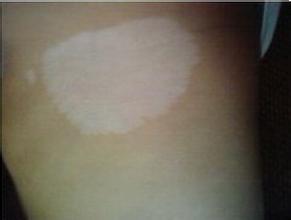 白癜风图片 白癜风图片