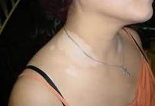 白癜风图片 白癜风图片