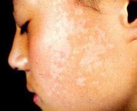 白癜风图片 白癜风图片