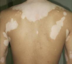 白癜风图片 白癜风图片