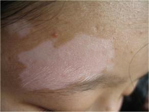 白癜风图片 白癜风图片