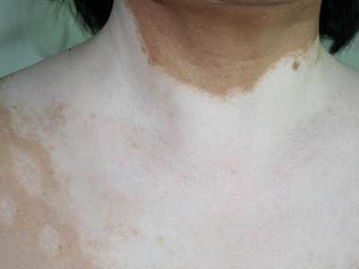 白癜风图片 白癜风图片