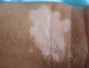 白癜风图片 白癜风图片