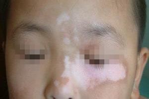 白癜风图片 白癜风图片