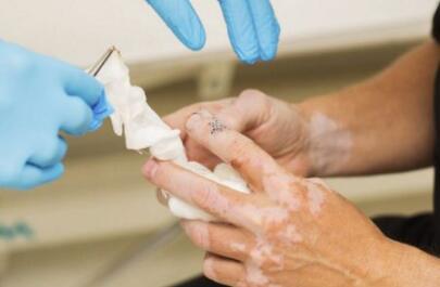 白癜风图片 白癜风图片